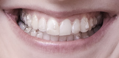 Jane-Invisalign.jpg