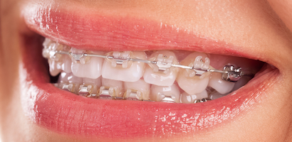 voksen lyse brackets ny