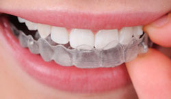 Jane-Invisalign.jpg