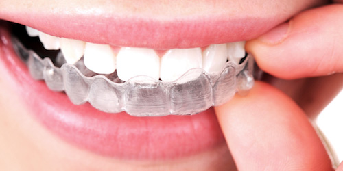 invisalign