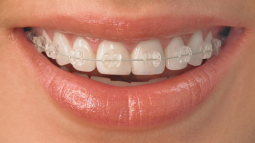 lyse brackets ny