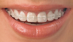 voksen lyse brackets ny